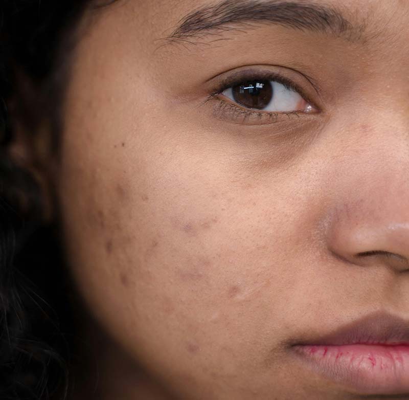Acne Scarring Treatment at LMS Clinic
