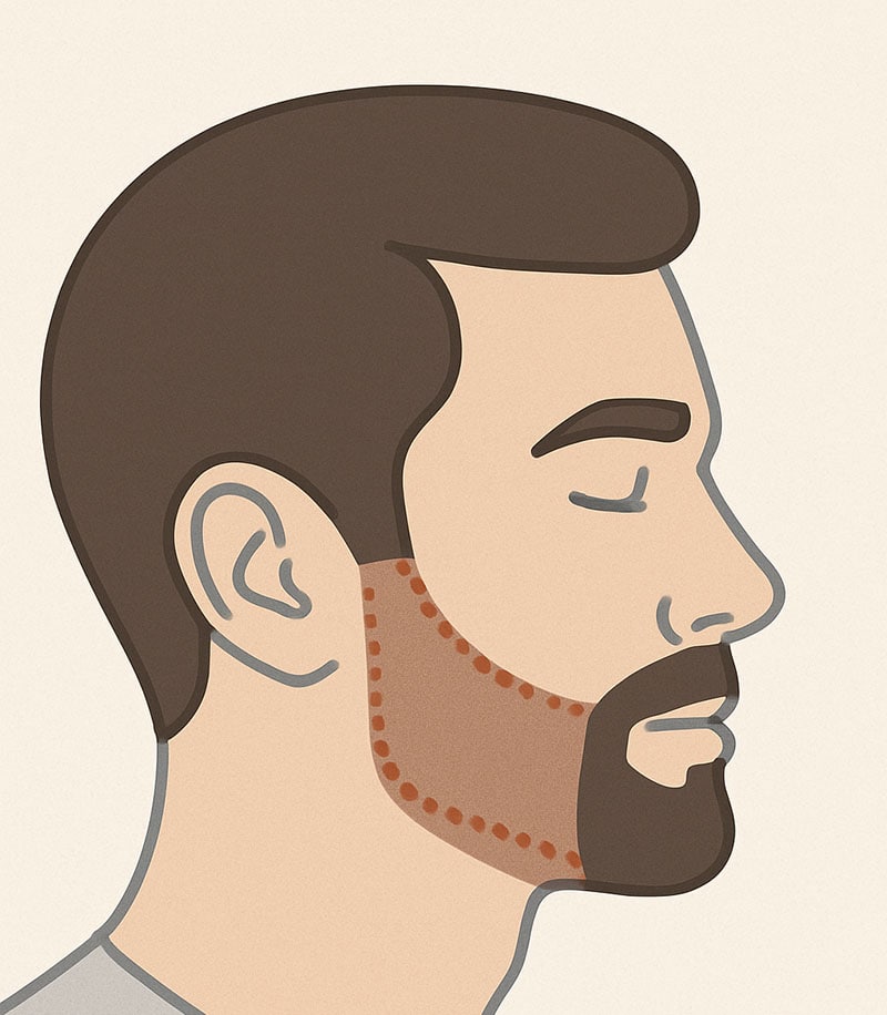 facial laser hair removal for men