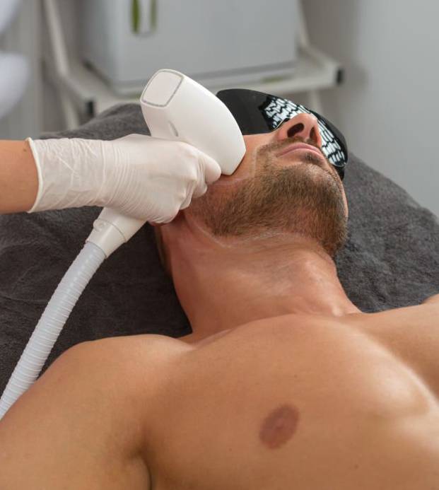 facial laser hair removal for men
