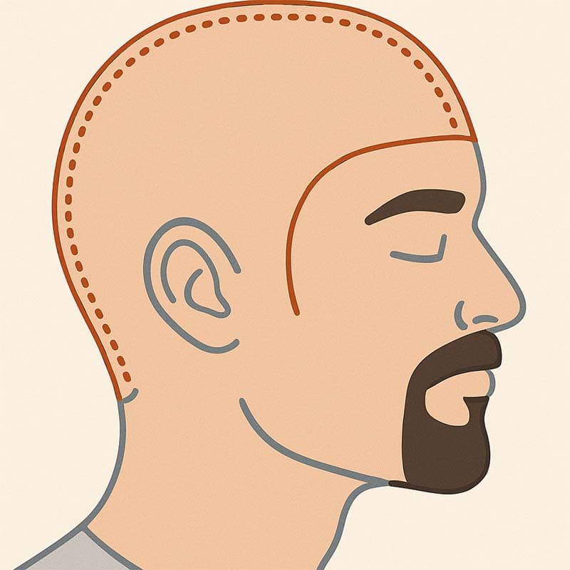 full head laser hair removal