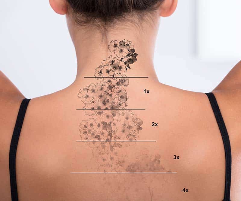 laser tattoo removal areas