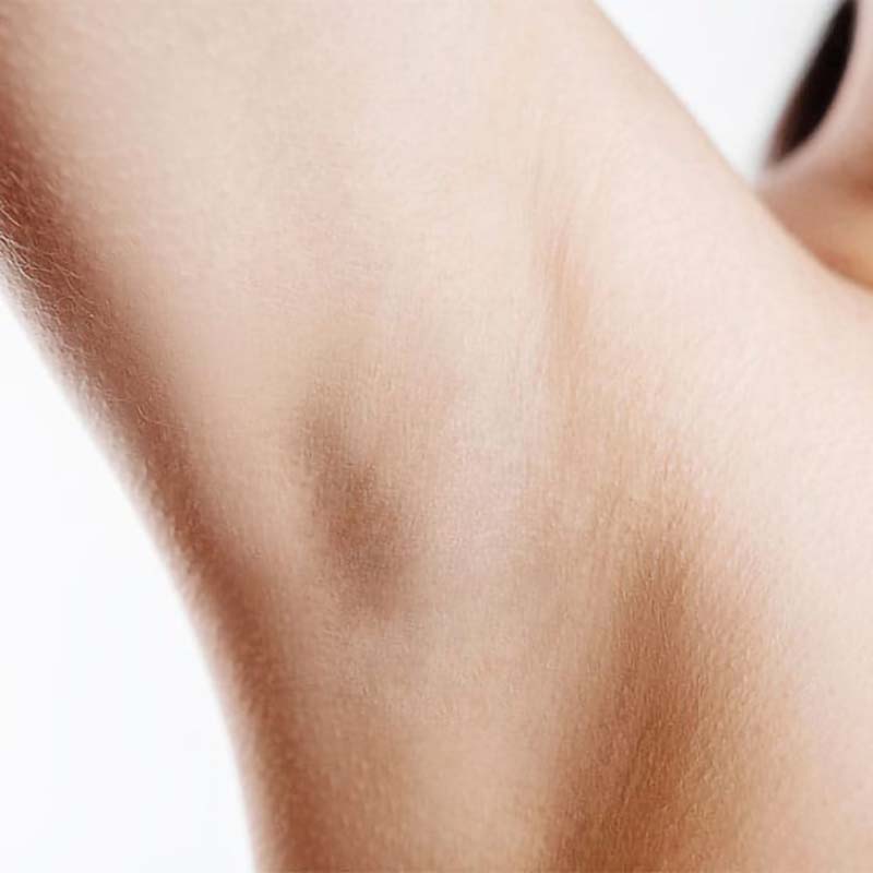 Before – underarms
