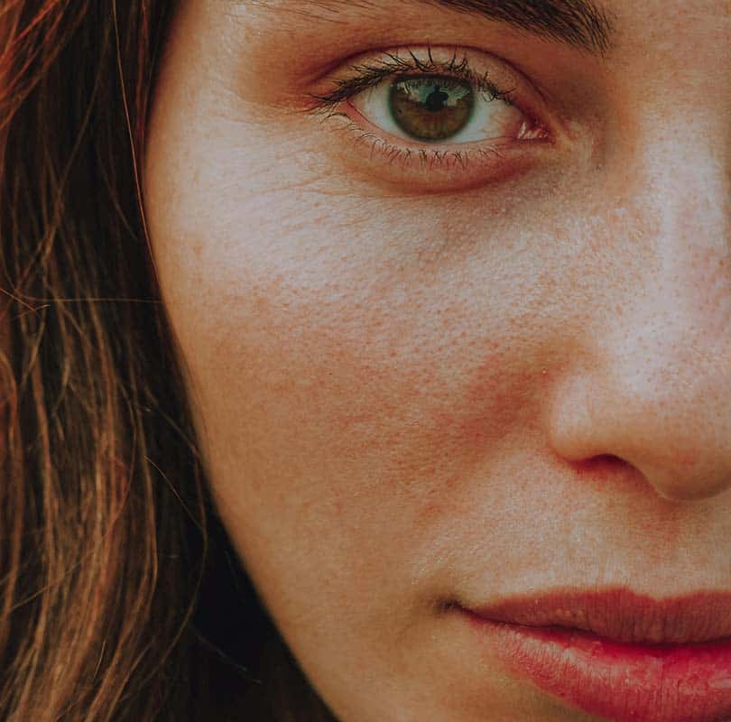 Upper Lip Treatment