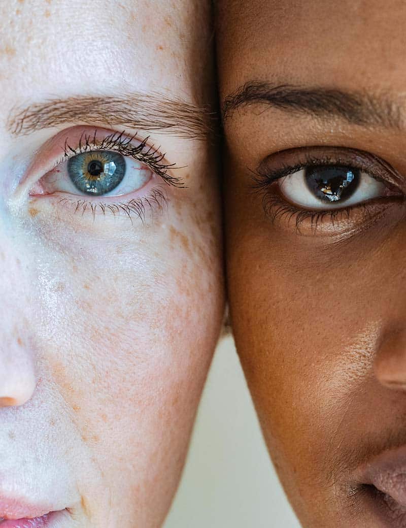 freckles skin treatment
